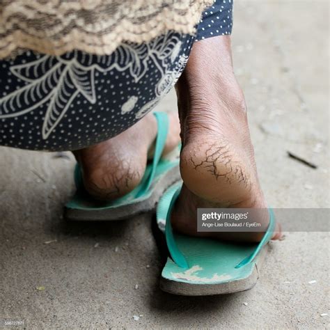 Close Up Of Cracked Soles Of Womans Feet Stock Photo ... Close Up Of Cracked Soles Of Womans Feet Stock Photo